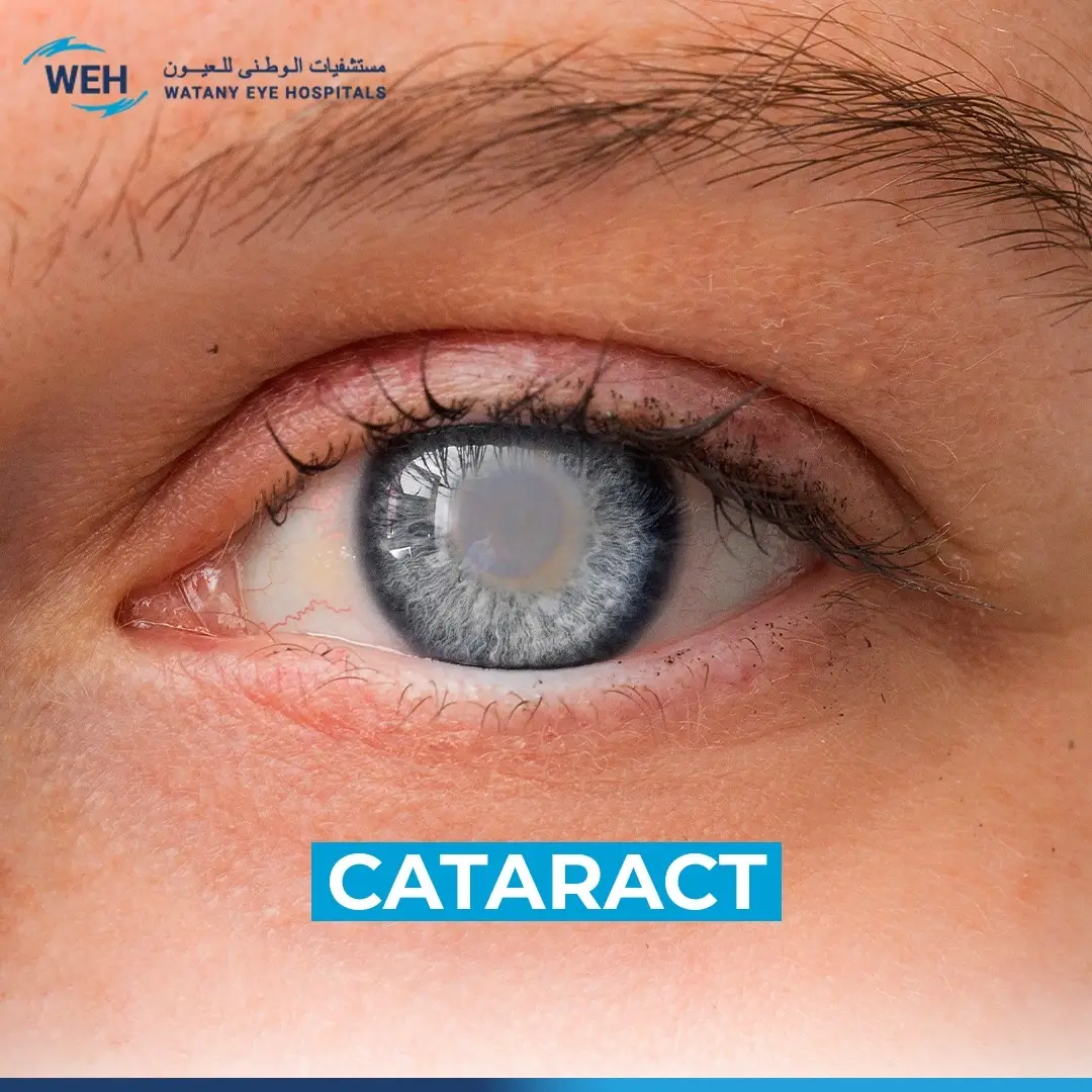 Cataracts: Symptoms and Treatment