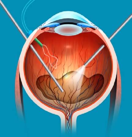 Vitreoretinal Surgery